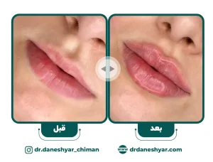 فیلر-لب-1
