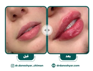 فیلر-لب-2