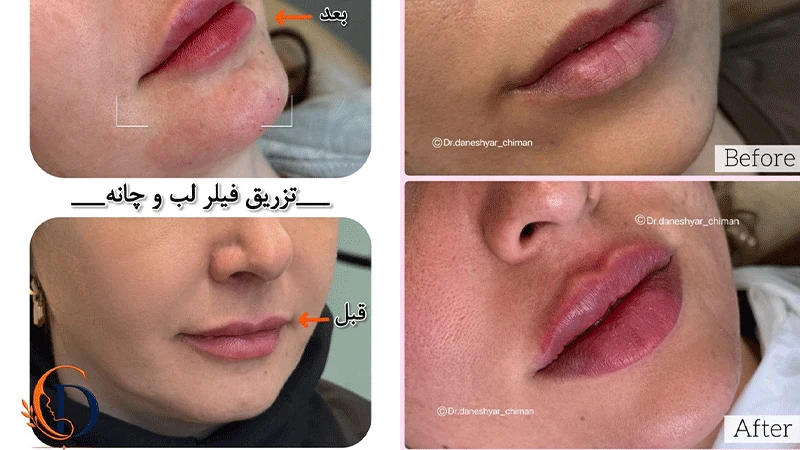 فیلر لب چیست