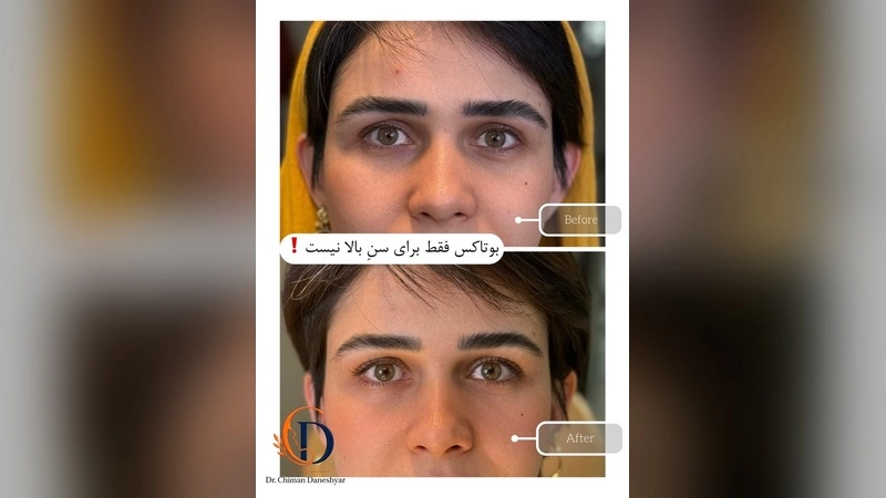 عوارض بوتاکس بعد از چند سال