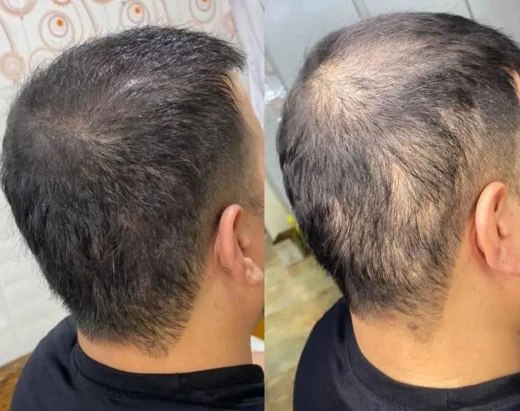 کاشت مو با تکنولوژی جدید